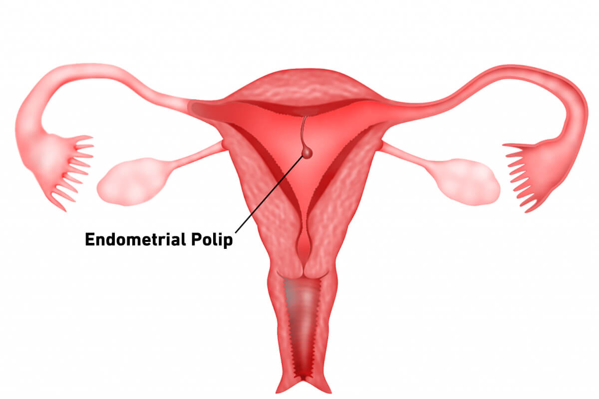 Endometrial Polip